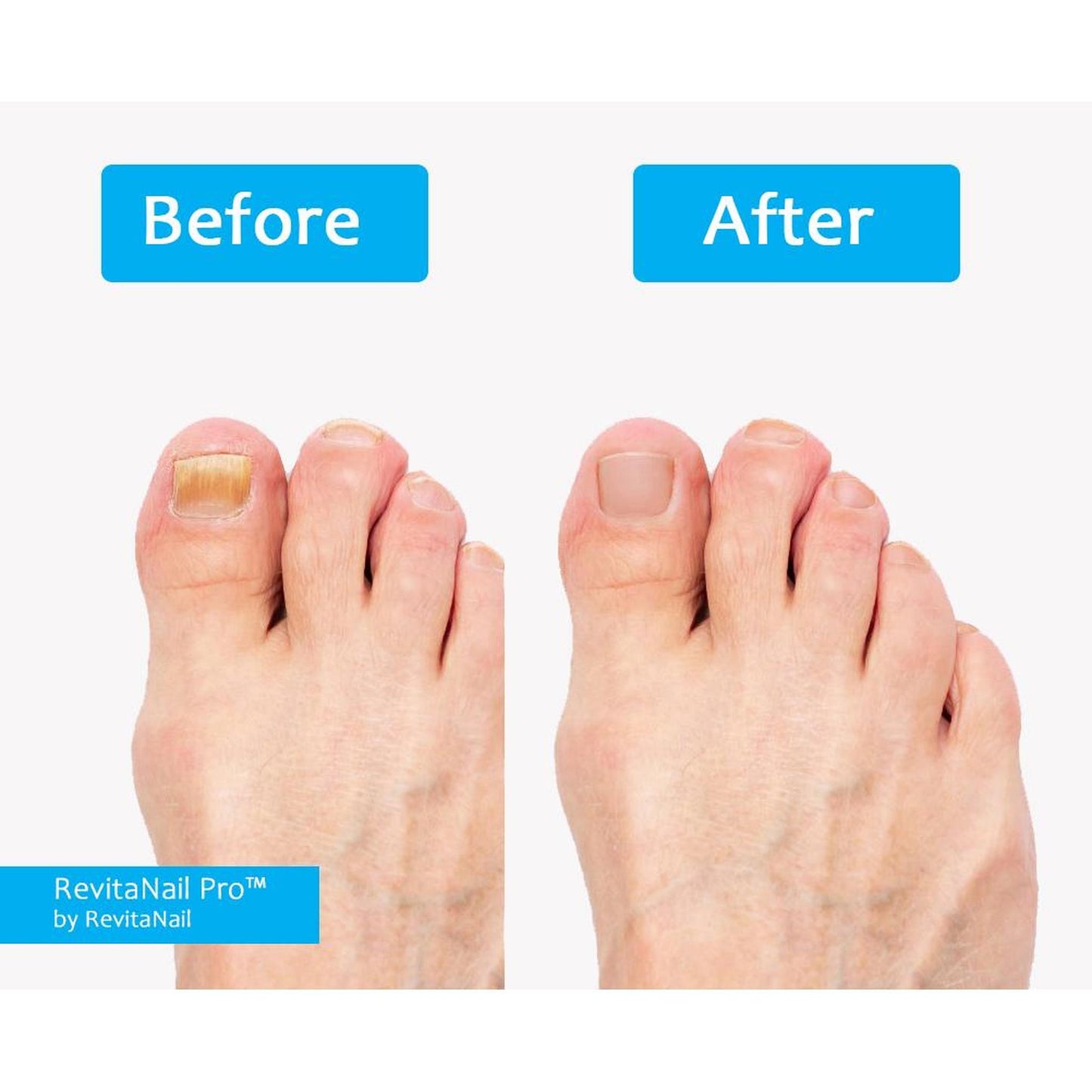 RevitaNail Pro™- Eliminate nail fungus in 30 days | Money-back guarantee