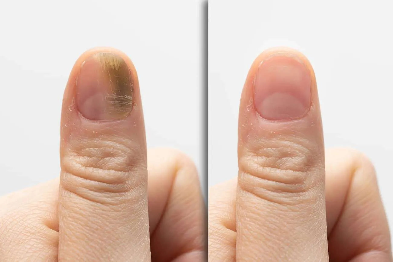 RevitaNail Pro™- Eliminate nail fungus in 30 days | Money-back guarantee