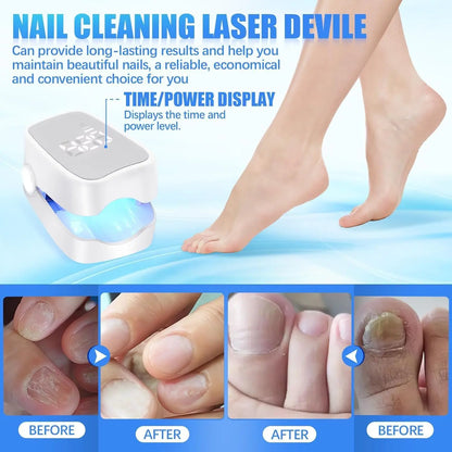OnyxNail™ – Say goodbye to fungal infections in 30 days | Money-back guarantee