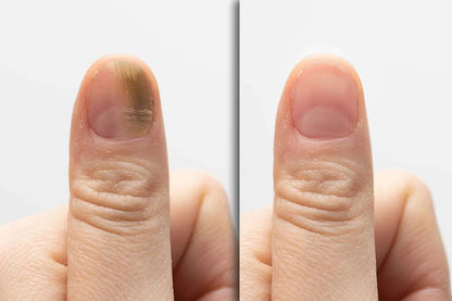 RevitaNail Pro™- Eliminate nail fungus in 30 days | Money-back guarantee
